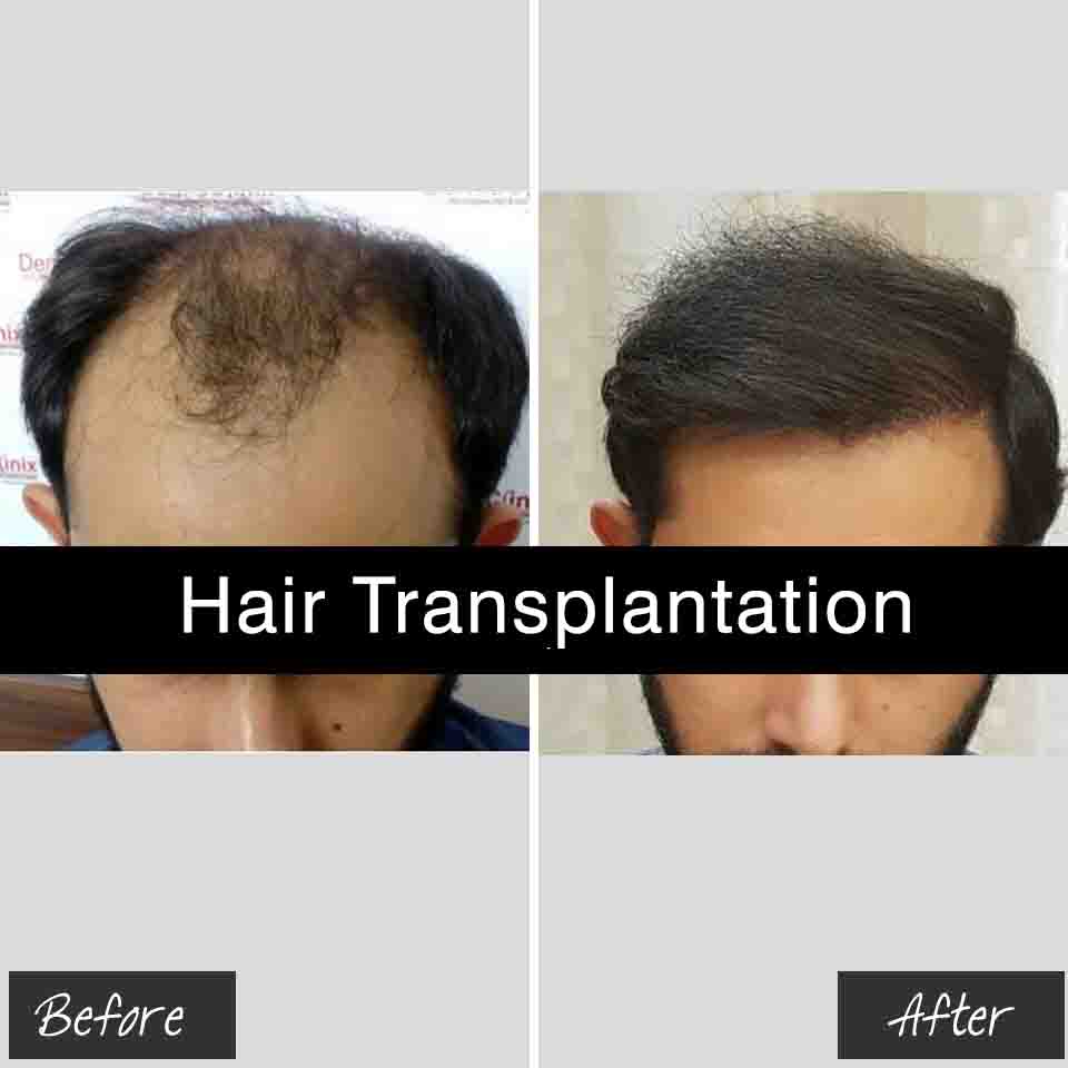hair-transplantation-treatment-in-jaipur_1 best hair transplant treatment in jaipur