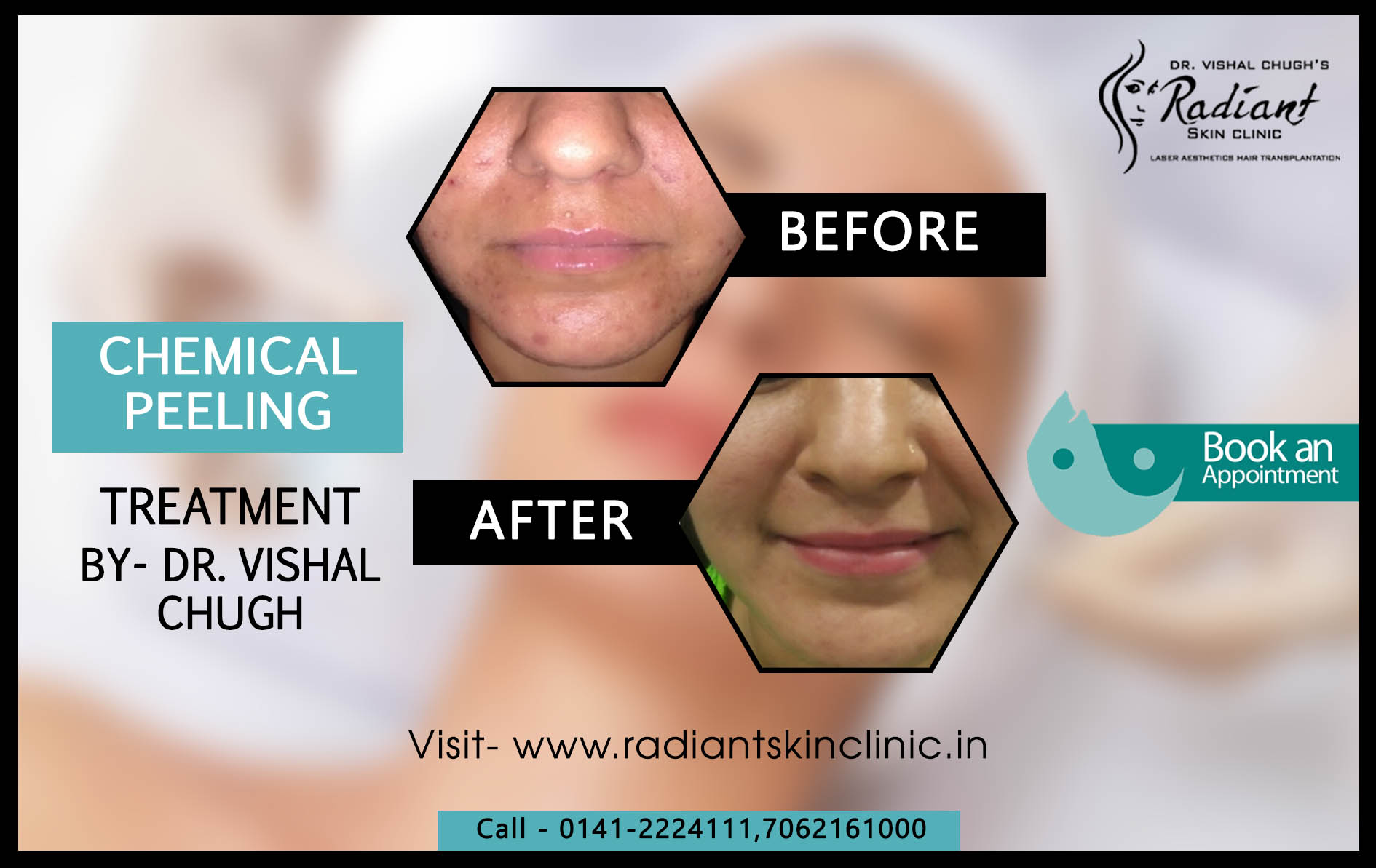 banner 117 Chemical peeling in jaipur