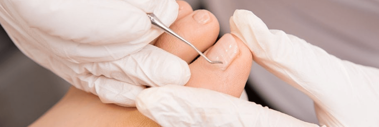 Nail surgery in jaipur Best nail surgery in jaipur