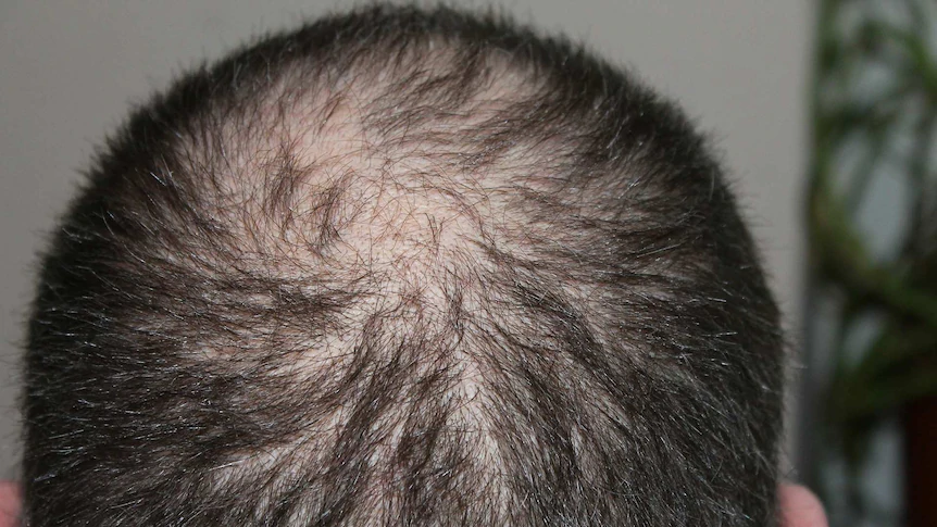1c2b03e1ec2e533c58299b5601fbb7c5 (1) best hair transplant treatment in jaipur