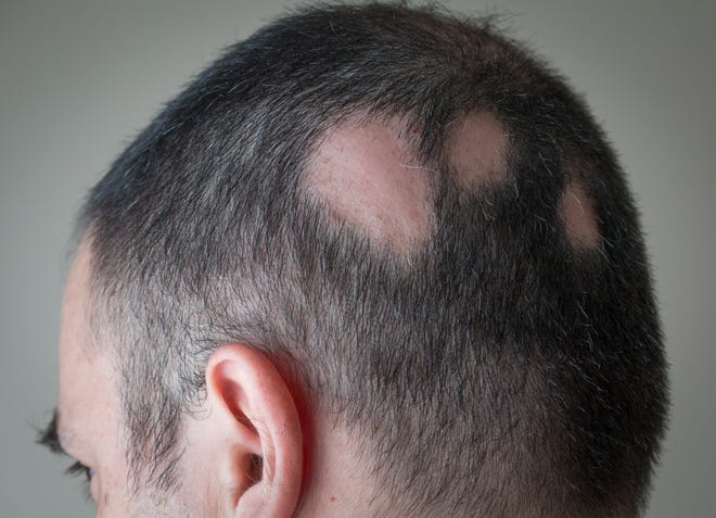 fc6dbc1e-0102-4f63-891a-83f28aadc229-GettyImages-653778784 best hair transplant treatment in jaipur