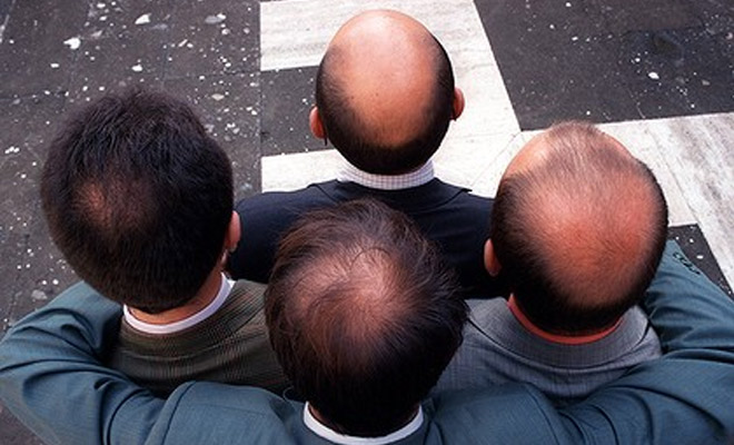 genetic-hair-loss best hair transplant treatment in jaipur