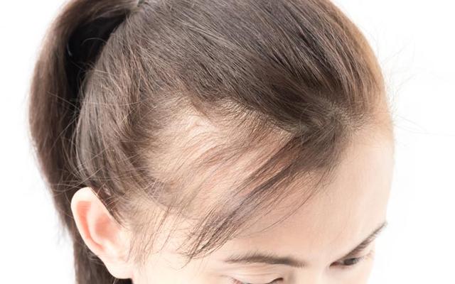 woman-serious-hair-loss-problem_1024x400 best hair transplant treatment in jaipur