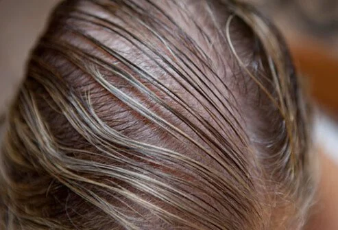 womens-thinning-hair-loss-s5-photo-of-thin-hair-on-crown best hair transplant treatment in jaipur