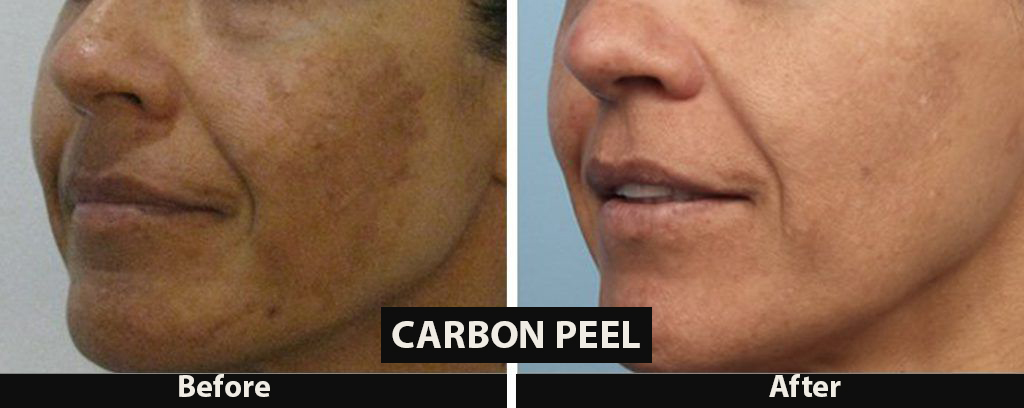Carbon peel 3