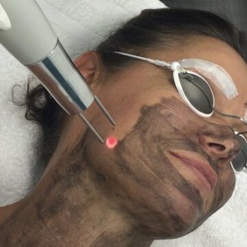 Hollywood Peeling Treatment in Jaipur Hollywood Peeling Treatment in Jaipur