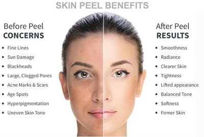 Benefits of hollywood skin peeling