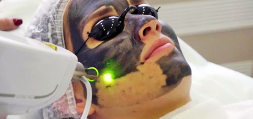 Carbon Peeling Treatment in Jaipur Best dermatologist for carbon peeling in Jaipur
