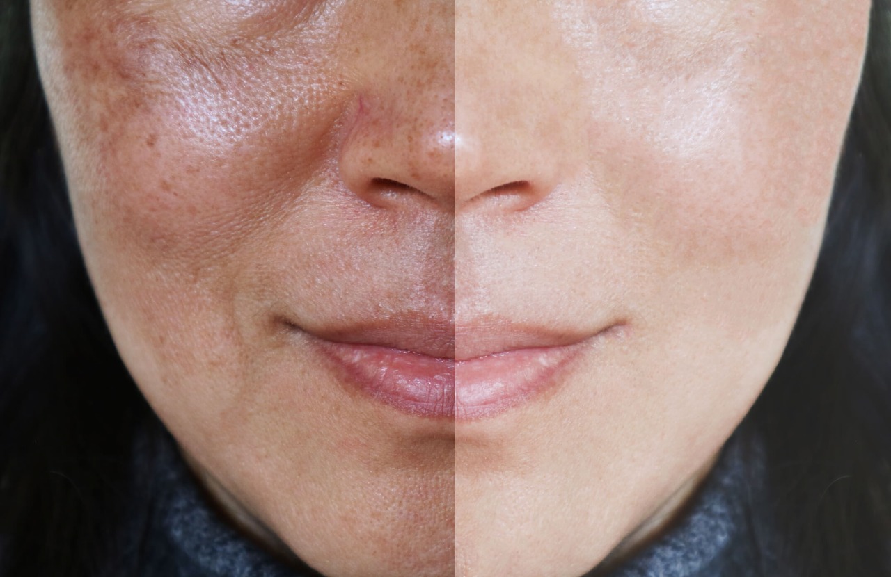 Hydrafacial skin treatment in Jaipur Hydrafacial skin treatment
