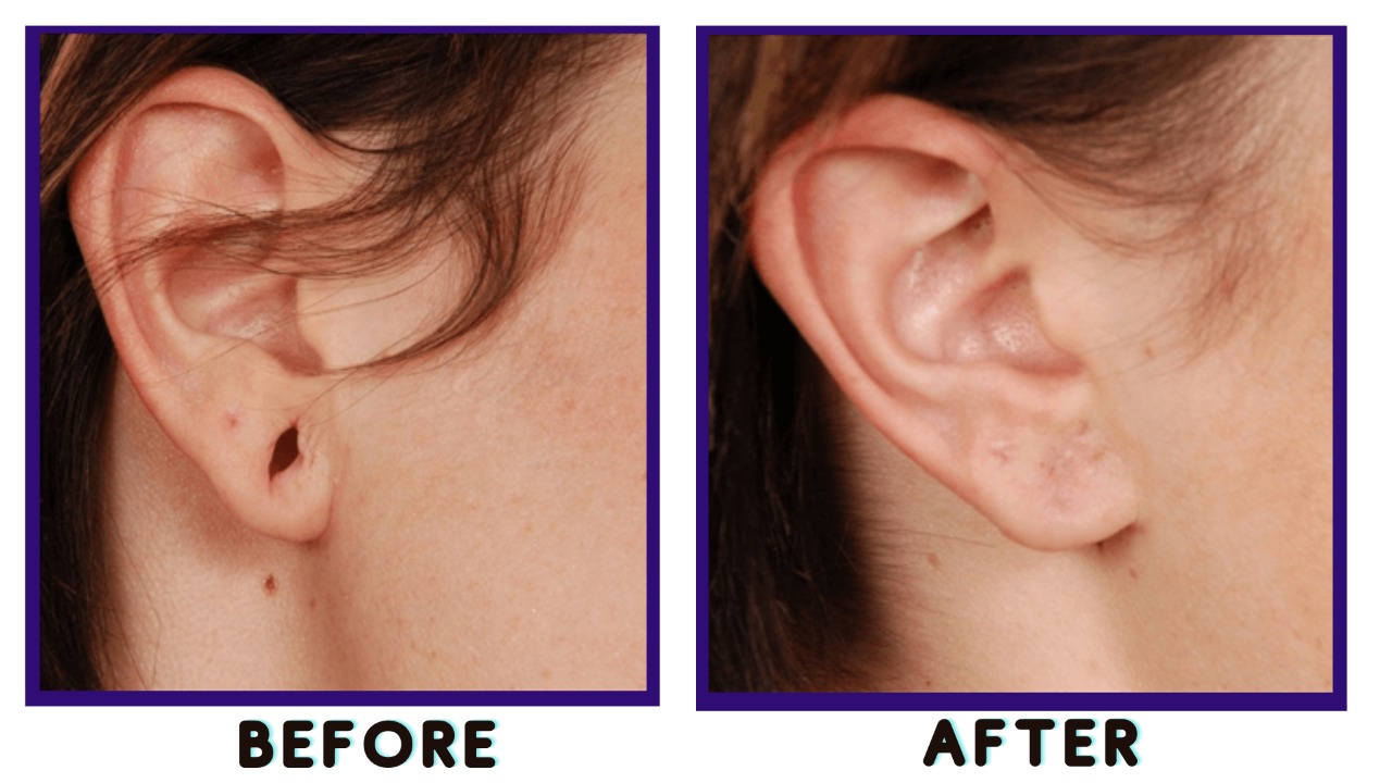 earlobe repair surgery before and after