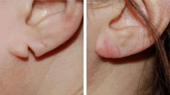 earlobe repair surgery in Jaipur earlobe repair treatment in jaipur