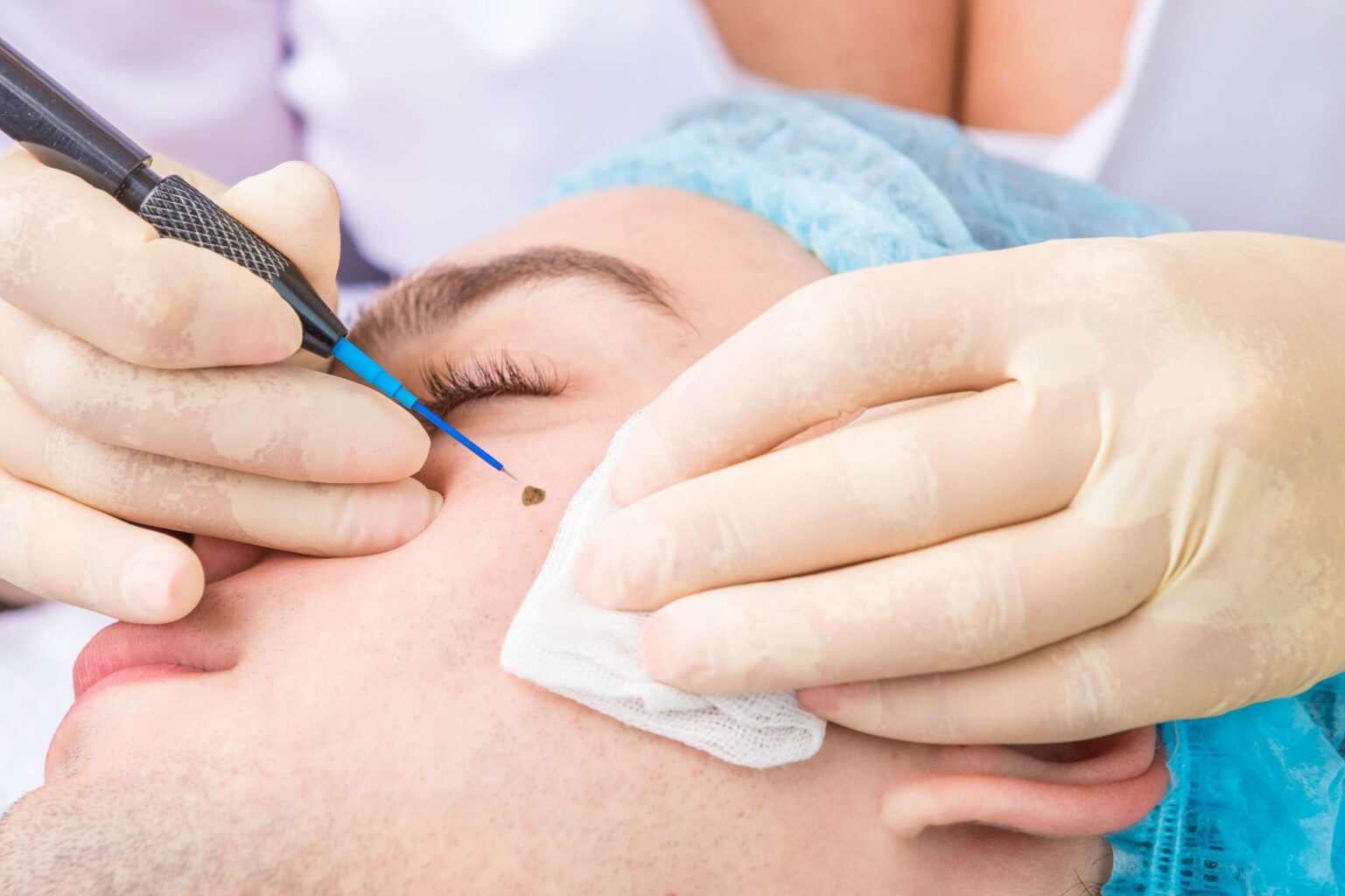 Cancerous mole removal