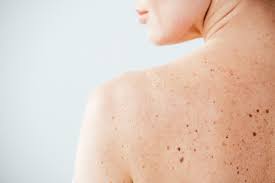 Mole removal