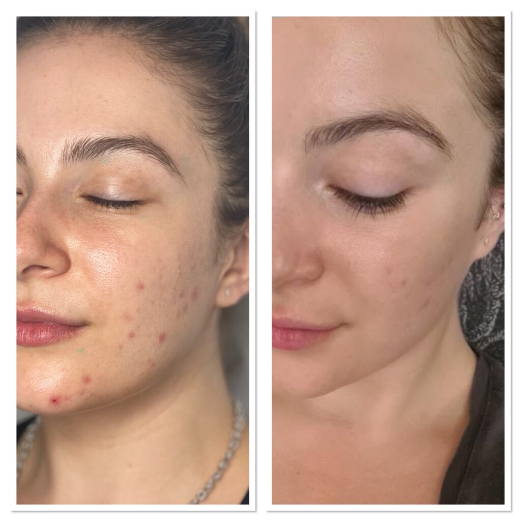 carbon-peel carbon peeling treatment in jaipur
