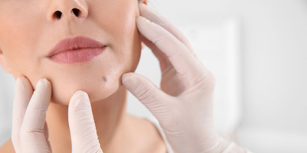 facial mole reomval in Jaipur