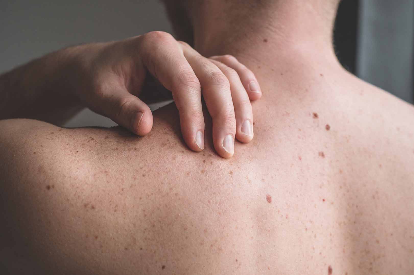 mole removal jaipur