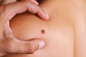 mole remval treatment in Jaipur