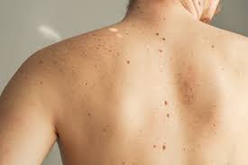 moles removal in Jaipur
