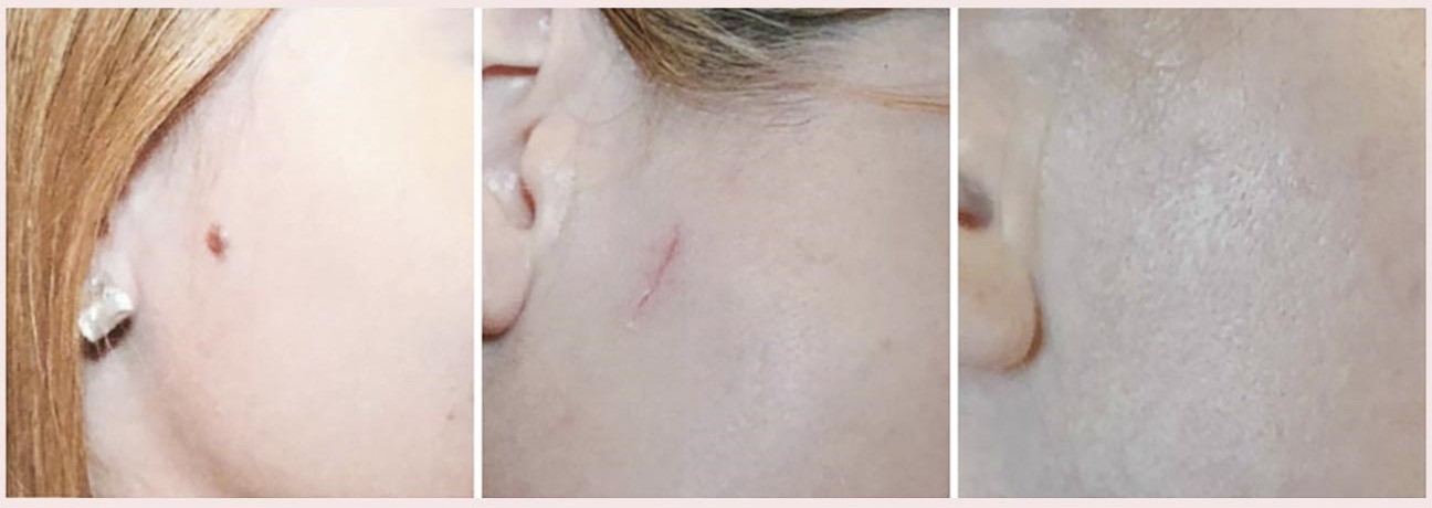 scar of mole removal