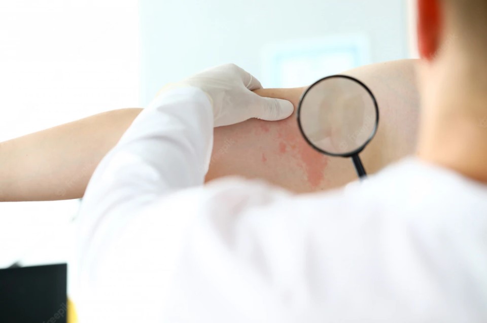 Eczema treatment eczema treatment Jaipur cost