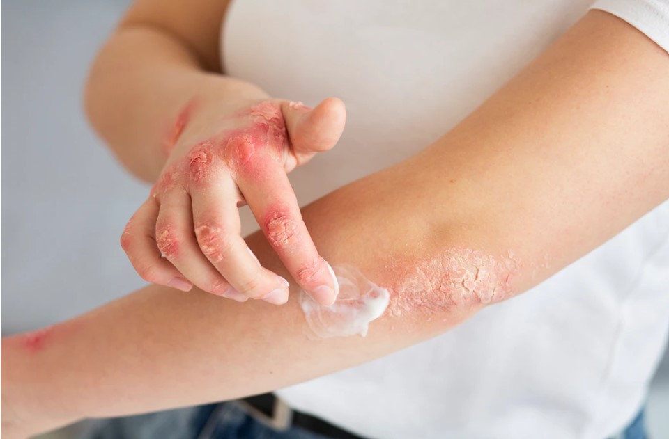 eczema treatment in Jaipur eczema treatment