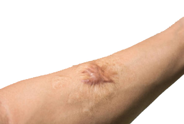 Keloids treatment Keloids treatment in Jaipur