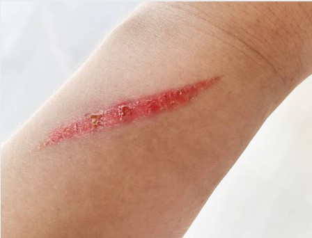 Keloid Treatment in Jaipur Keloid Treatment in Jaipur