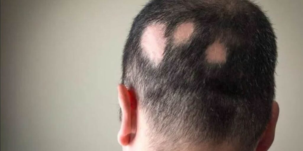 Alopecia Treatment in Jaipur Alopecia treatment