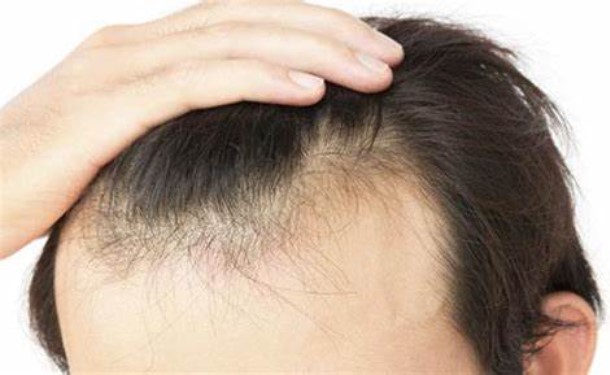 Alopecia Treatment Symptoms and Cost Symptoms of Alopecia