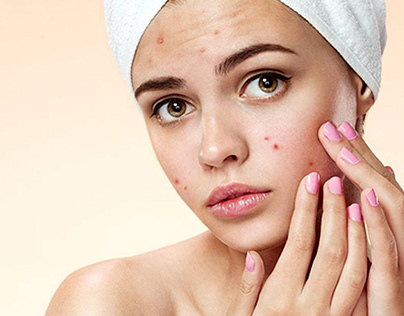 Mederma for Acne scars