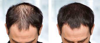 alopecia 1