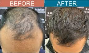 alopecia 2