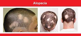 alopecia 3