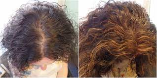 alopecia 6