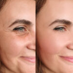 best botox treatment