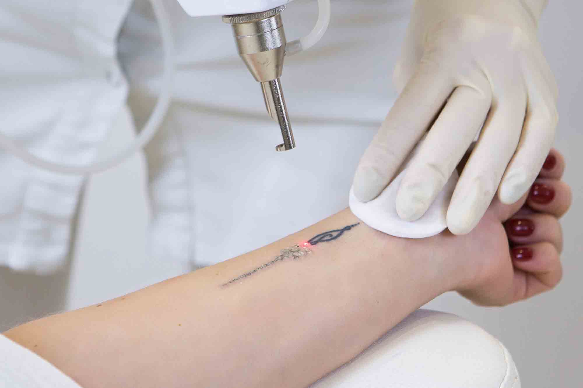 laser tattoo removal