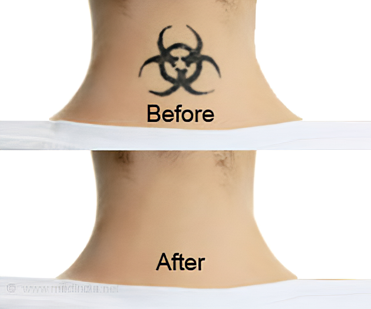 tattoo removal back