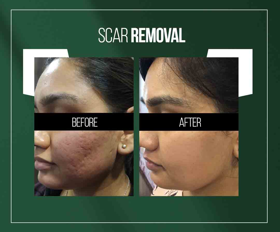 acne scar removal treatment in jaipur by dr vishal chugh acne scar removal treatment in jaipur by dr vishal chugh