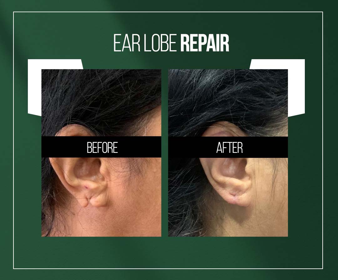 earlobe repair treatment in jaipur by dr vishal chugh earlobe repair treatment in jaipur by dr vishal chugh