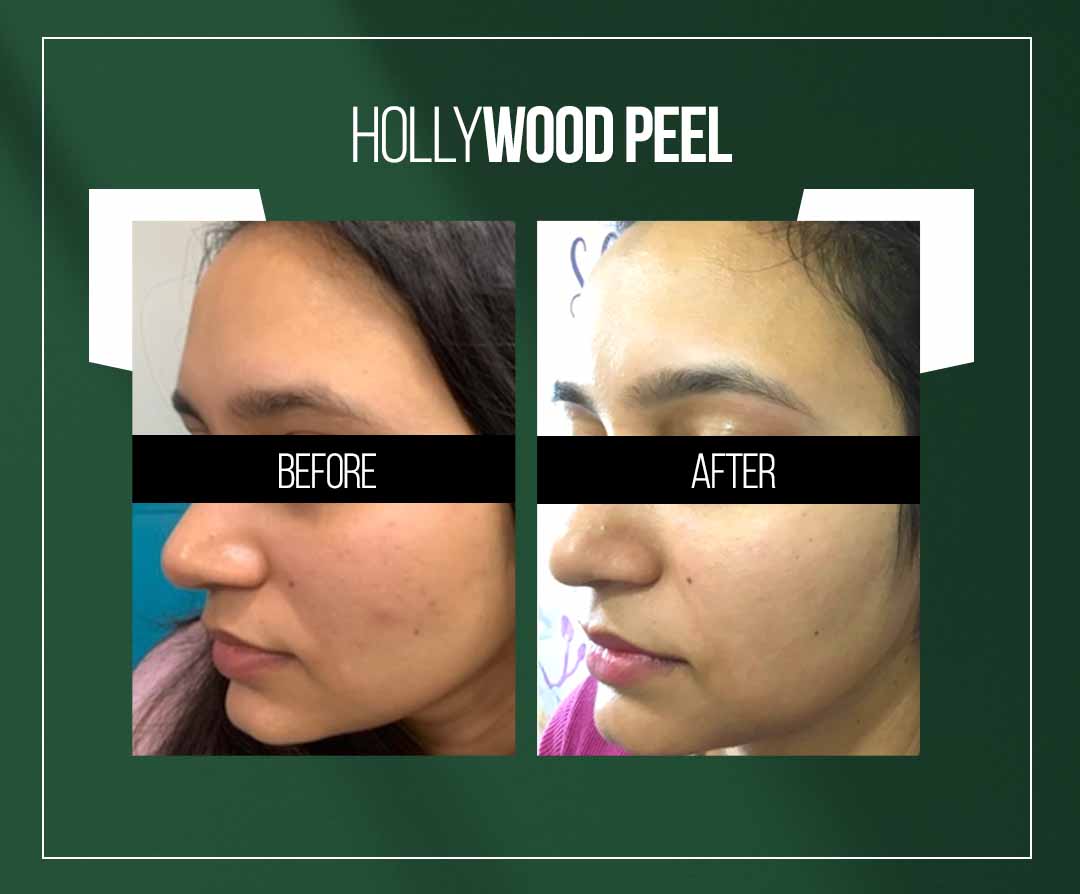 hollywood peel treatment in jaipur hollywood peel treatment in jaipur