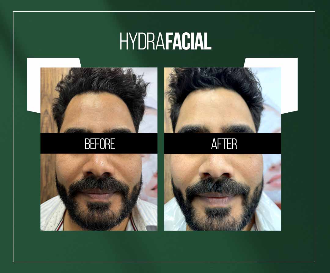 hydrafacial treatment in jaipur hydrafacial treatment in jaipur