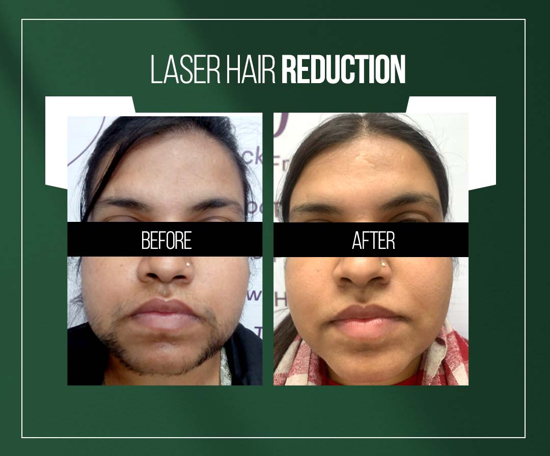 laser hair reduction treatment in jaipur by dr vishal chugh laser hair reduction treatment in jaipur by dr vishal chugh