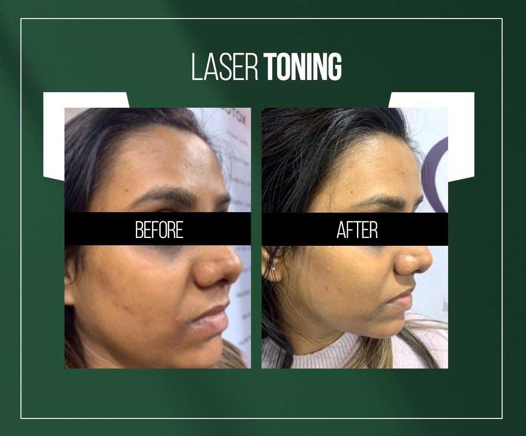 laser toning treatment skin whitening treatment in jaipur laser toning treatment skin whitening treatment in jaipur