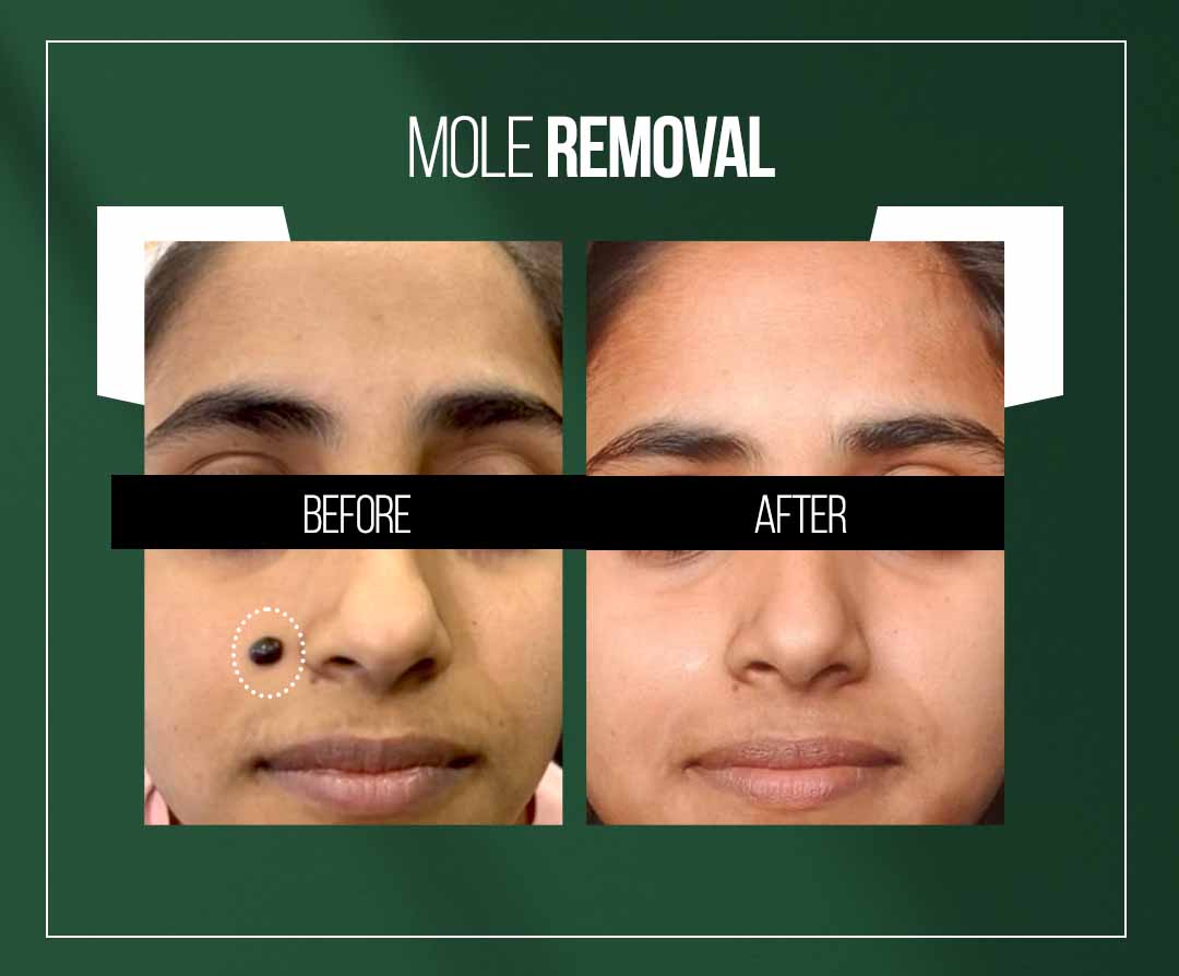 mole removal treatment in jaipur by dr vishal chugh mole removal treatment in jaipur by dr vishal chugh