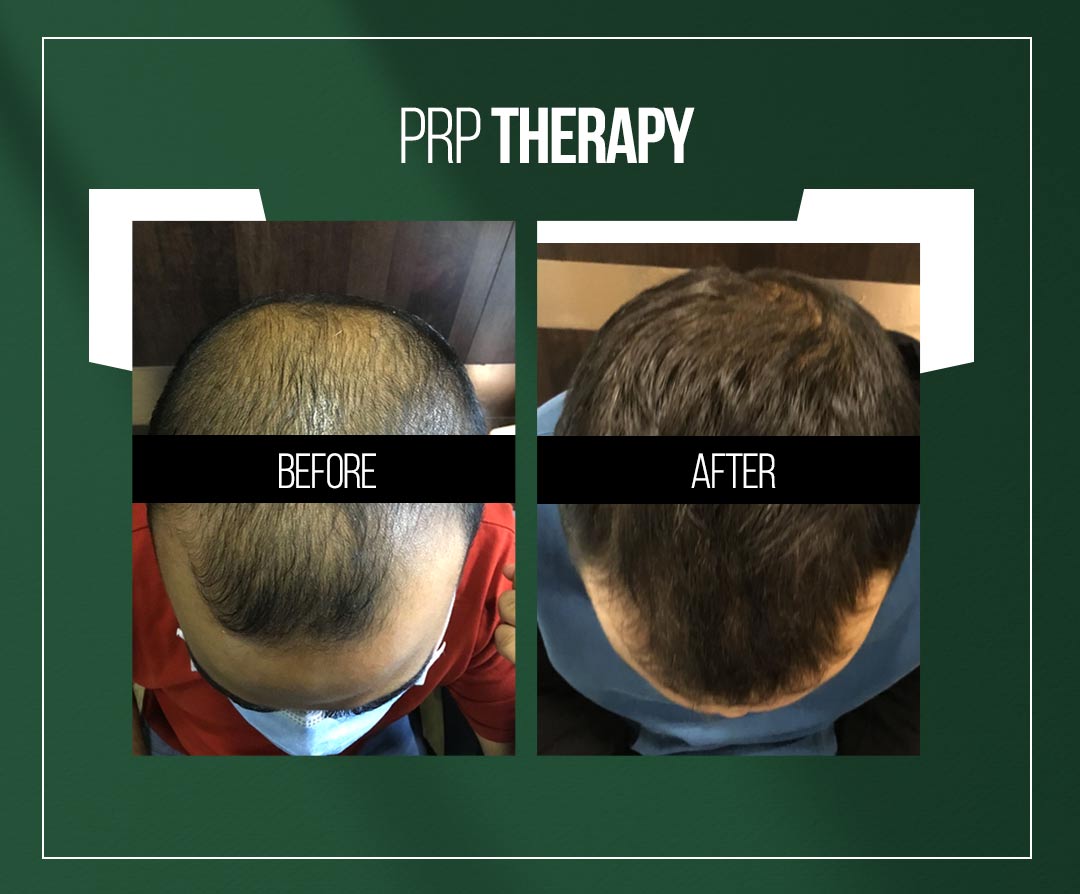 prp-therapy-treatment-for-hair-loss-in-jaipur-by-dr-vishal-chugh prp-therapy-treatment-for-hair-loss-in-jaipur-by-dr-vishal-chugh