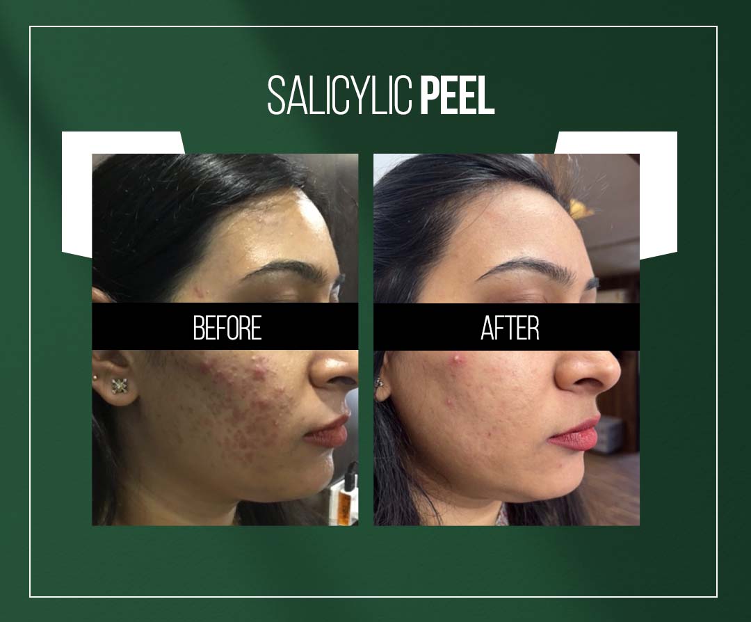 salicylic peel treatment in jaipur for acne scars salicylic peel treatment in jaipur for acne scars