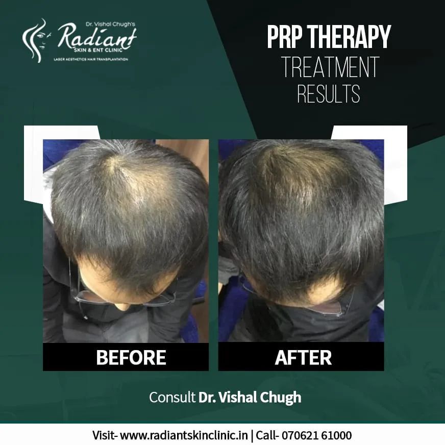 prp-treatment-in-jaipur PRP Treatment in Jaipur