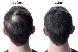Hair Fall Treatment