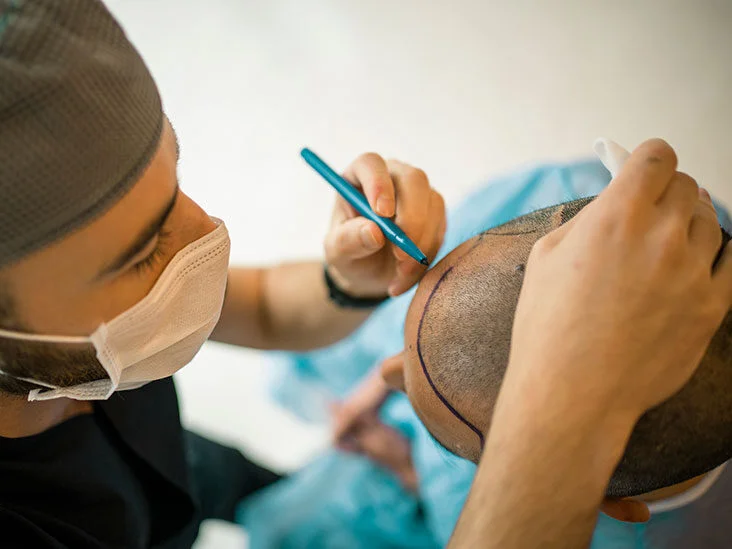Hair Transplant Clinic in Jaipur
