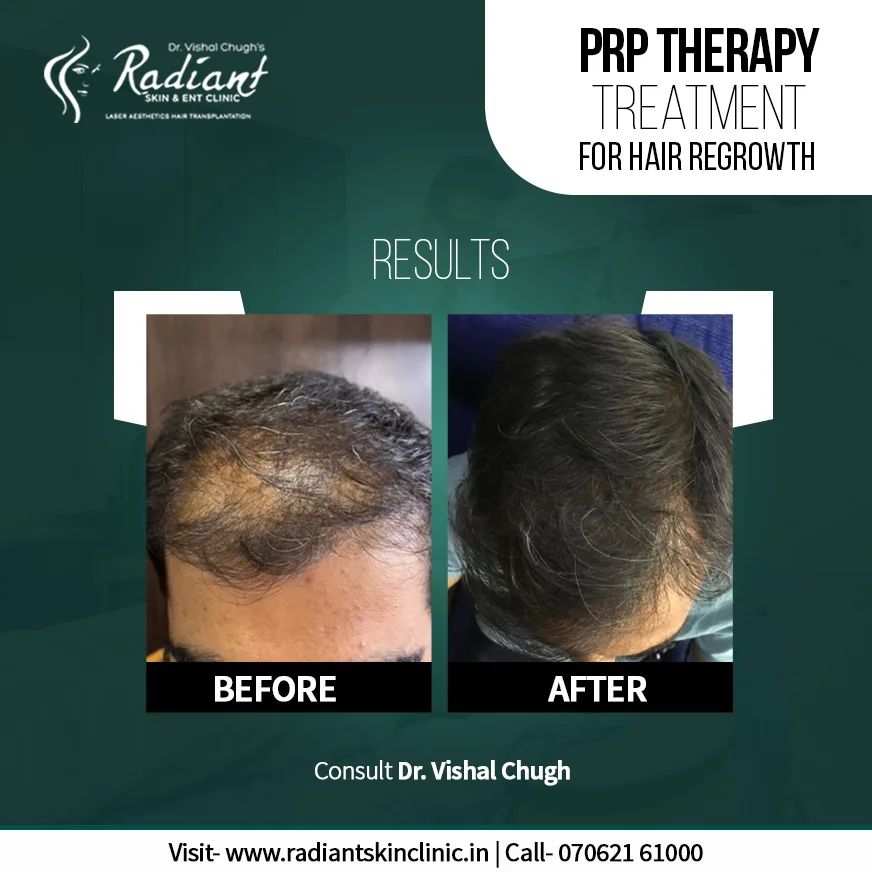 radiantskinclinic_jaipur_352586123_216297694582133_3479509438711007795_n PRP Treatment in Jaipur
